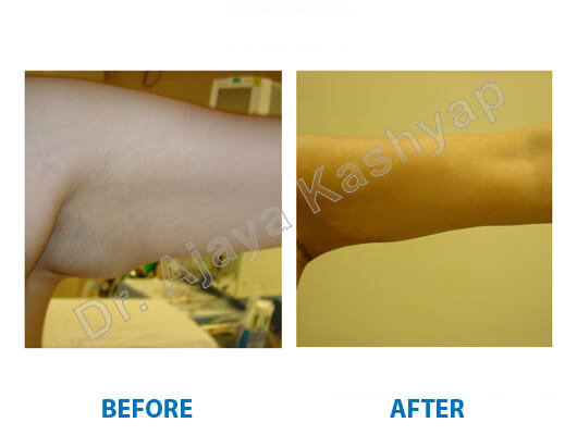 arm lift procedure in India